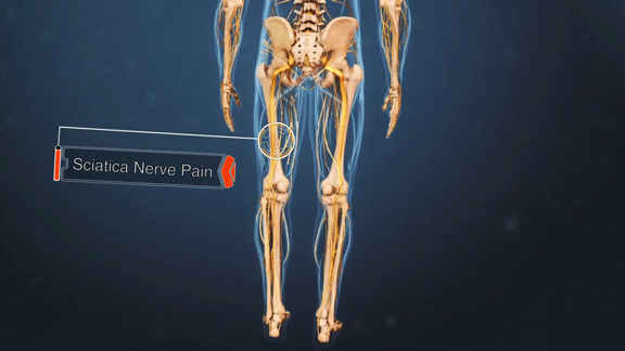 Sciatica Nerve Pain